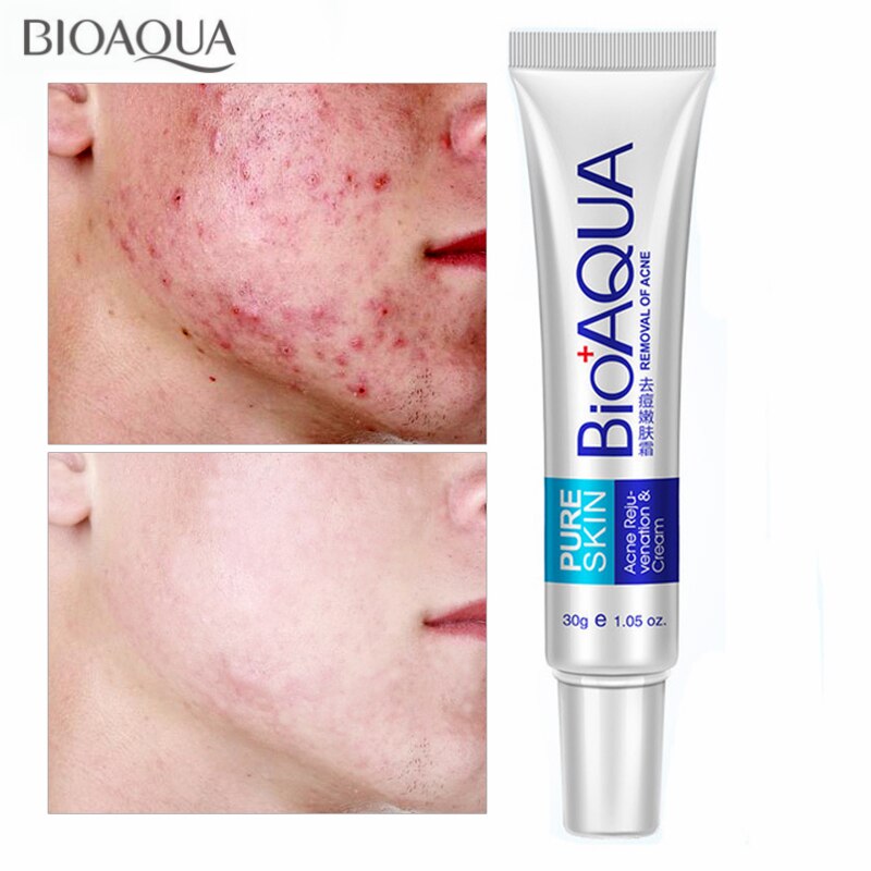 BIOAQUA-Blackhead-Remove-Acne-Treatment-Anti-Acne-Cream-Oil-Control-Shrink-Pores-Acne-Scar-Removal-Gel