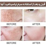 سرم نیاسینامید آنوا | ضد لک و روشن کننده اصل کره - تصویر 3