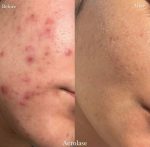 کرم ترمیم کننده لاروش پوزای سیکاپلاست بوم بی۵ پلاس - تصویر 4