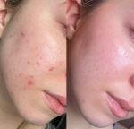 ژل شستشوی ضد جوش بیوکسین حجم 500 میلی - تصویر 3